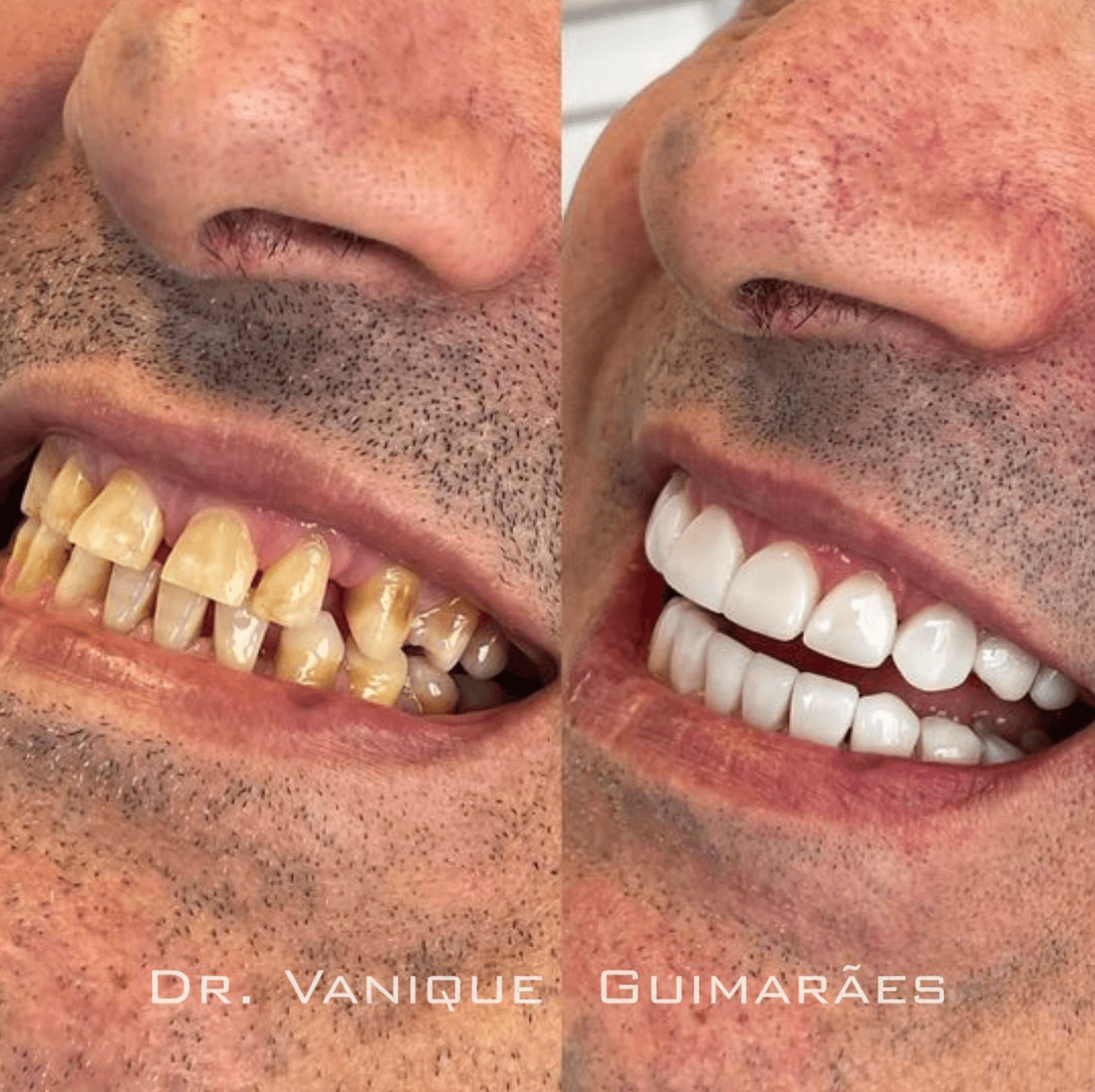 Antes e depois 3