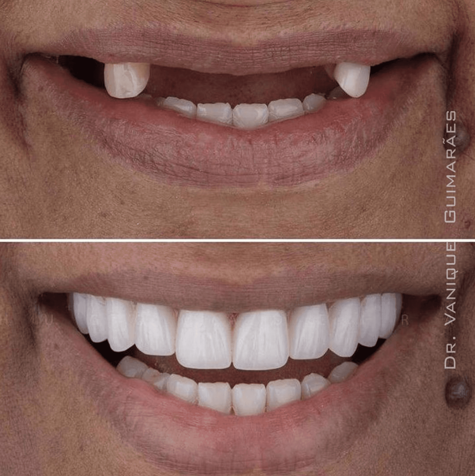 Antes e depois 4